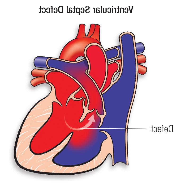 VSD diagram