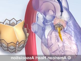 TAVR animation