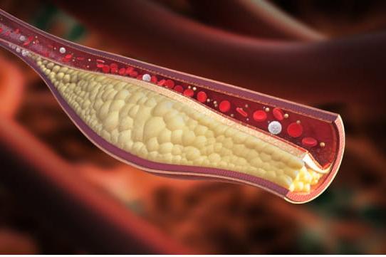 动脉内胆固醇的特写图